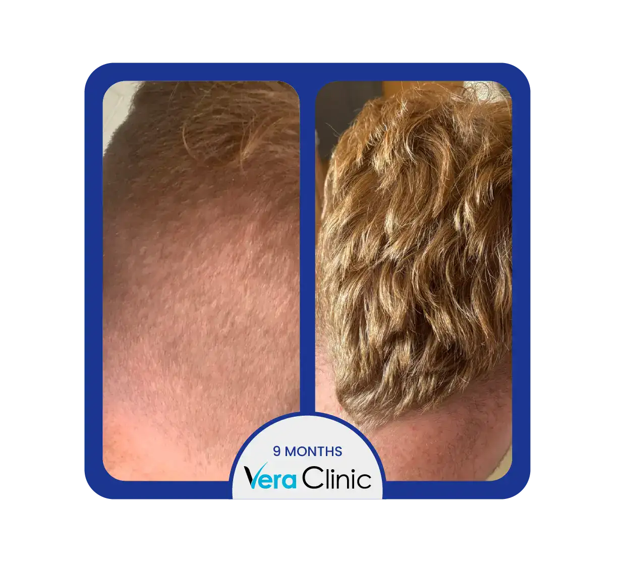 1500 Haartransplantationen vor und nach der Behandlung in der Vera Clinic, Türkei, mit verbesserter Dichte im Stirnbereich und natürlich aussehendem Nachwachsen