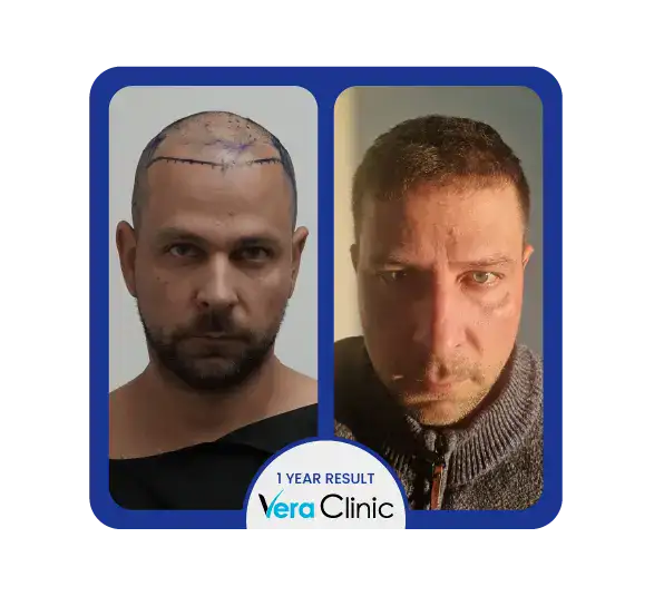 2000 Transplantate Haartransplantation vor und nach den Ergebnissen in der Vera Clinic, Istanbul, zeigen eine vollere Abdeckung der mittleren Kopfhaut und sichtbares Nachwachsen.