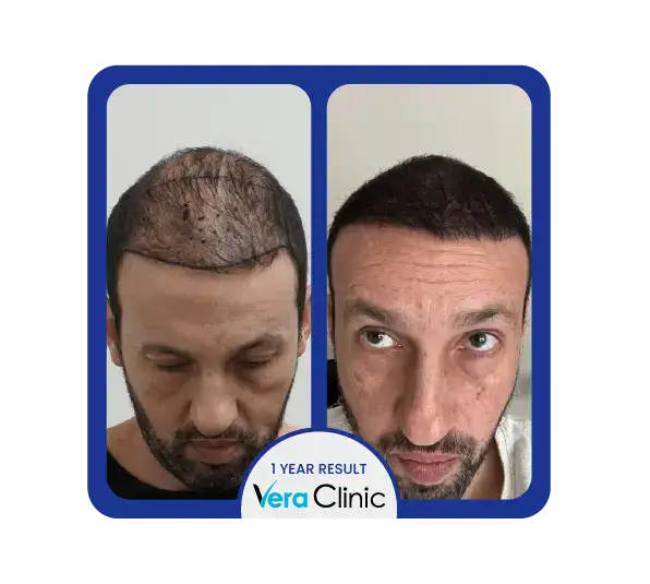 2500 Transplantate Haartransplantation vor und nach den Ergebnissen in der Türkei, Vera Clinic zeigt eine ausgewogene Dichte und natürliche Haarverteilung