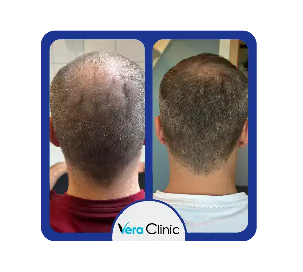 FUE-Spenderbereich vor und nach der Behandlung in der Vera Clinic, der eine präzise Transplantation mit minimaler Narbenbildung und einem gesunden Heilungsprozess zeigt.