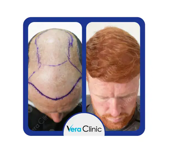 Haartransplantation vor und nach 3000 Transplantaten in der Vera Clinic in Istanbul, die eine verbesserte Abdeckung und eine natürliche Wiederherstellung des Scheitels zeigen.