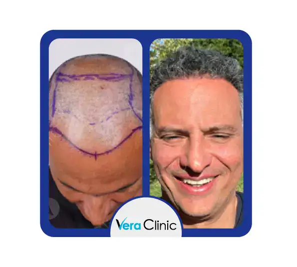 3500 Haartransplantationen vor und nach der Behandlung in Istanbul, Vera Clinic mit Schwerpunkt auf der Rekonstruktion eines dichten Haaransatzes und einer gleichmäßigen Dichte