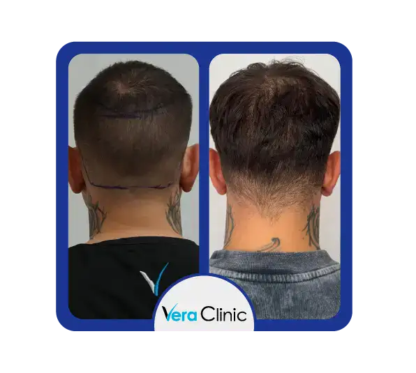 Ergebnisse der DHI-Spenderzone in der Vera Clinic in Istanbul mit sauberen Entnahmebereichen und gleichmäßigem Haarwachstum nach der Implantation