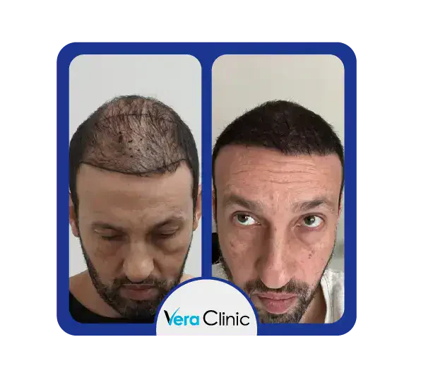 4000 Haartransplantate – Ergebnisse einer Haartransplantation in der Vera Clinic mit umfassender Abdeckung und dichtem Nachwachsen auf der gesamten Kopfhaut