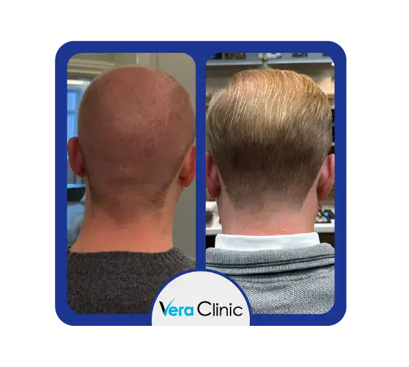 Sapphire FUE-Spenderbereich vor und nach der Behandlung in der Vera Clinic, der eine reibungslose Heilung, minimales Trauma und natürliches Nachwachsen nach der Entnahme zeigt.