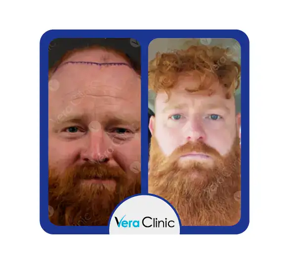 4500 Transplantate Haartransplantation vor und nach den Ergebnissen in der Istanbul Vera Clinic zeigen eine vollständige Haarwiederherstellung und eine starke Verbesserung der Haardichte.