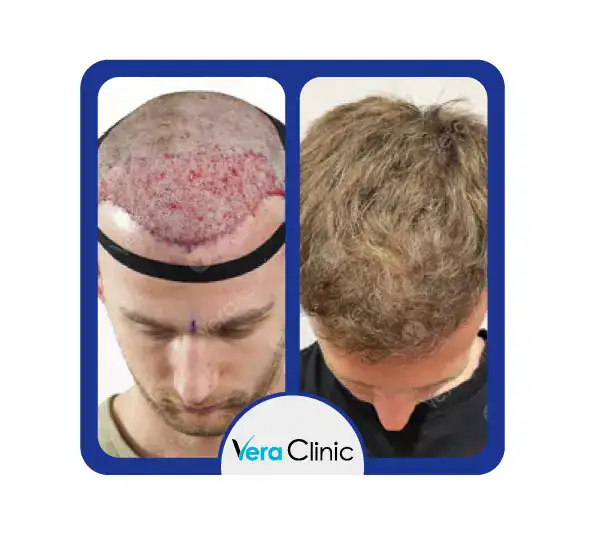 5000 Haartransplantationen vor und nach Fotos in der Vera Clinic zeigen eine vollständige Transformation der Kopfhaut mit natürlichen, hochdichten Ergebnissen.