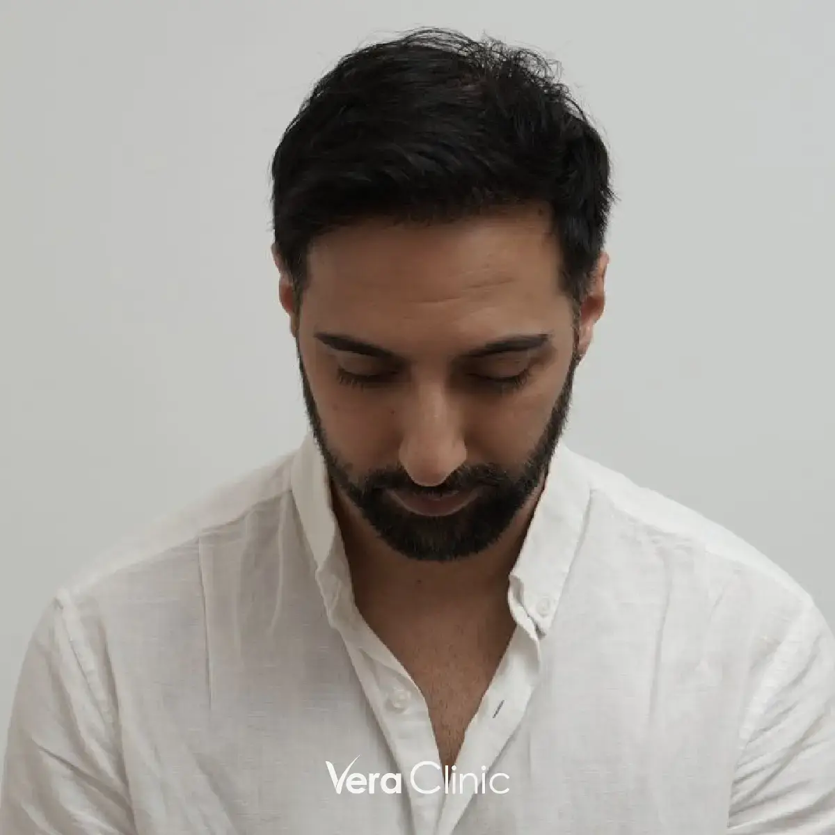 Amit-Prominenter vor der Haartransplantation mit Stirnglatze und zurückgehendem Haaransatz