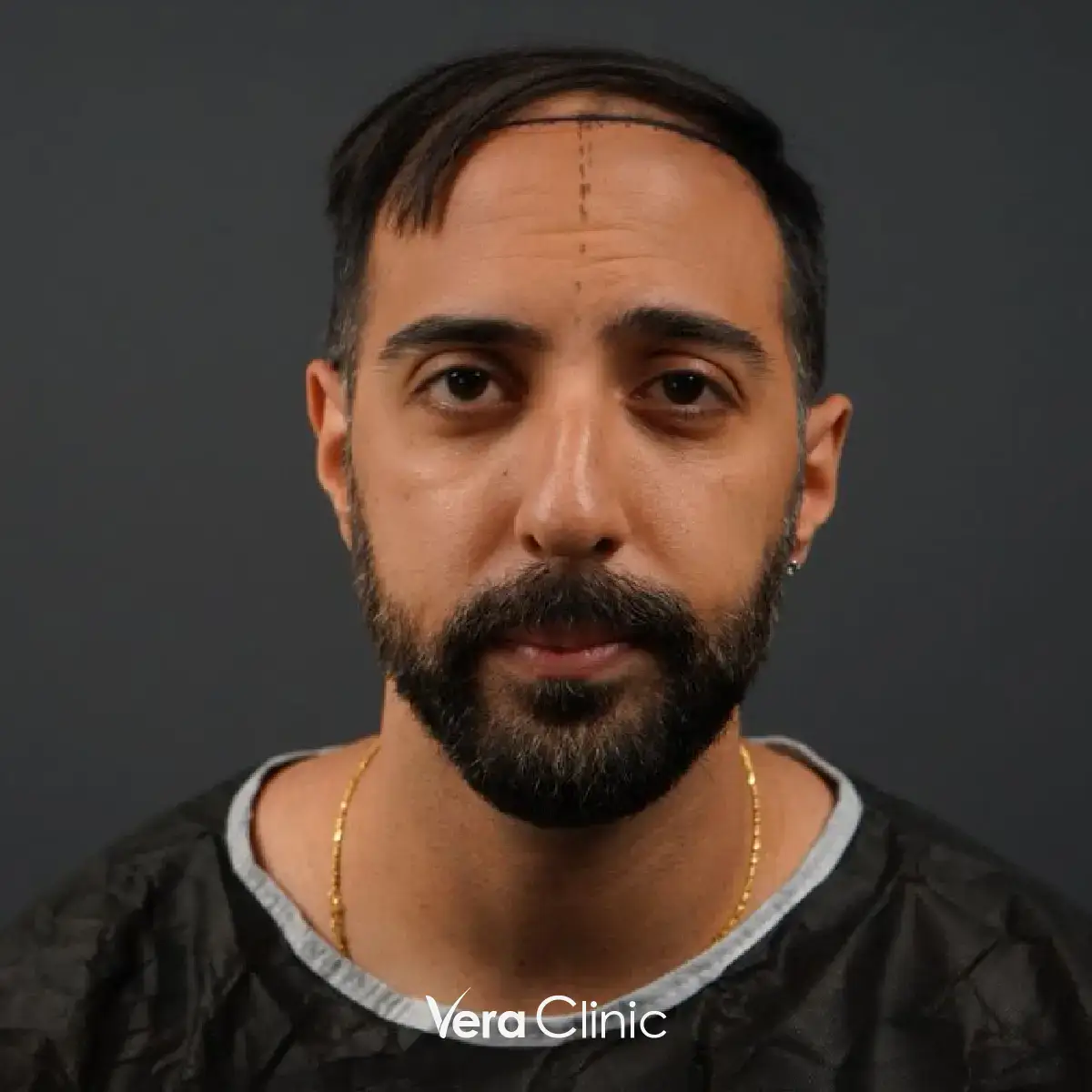 Amit, Prominenter nach Haartransplantation in der Vera Clinic, Istanbul, mit verbessertem Haaransatzdesign und dichtem Nachwachsen der Haare