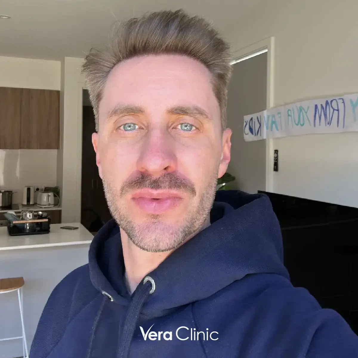 Jamie Perkins vor seiner Haartransplantation mit schütterem Haar und reduziertem Volumen am Scheitel