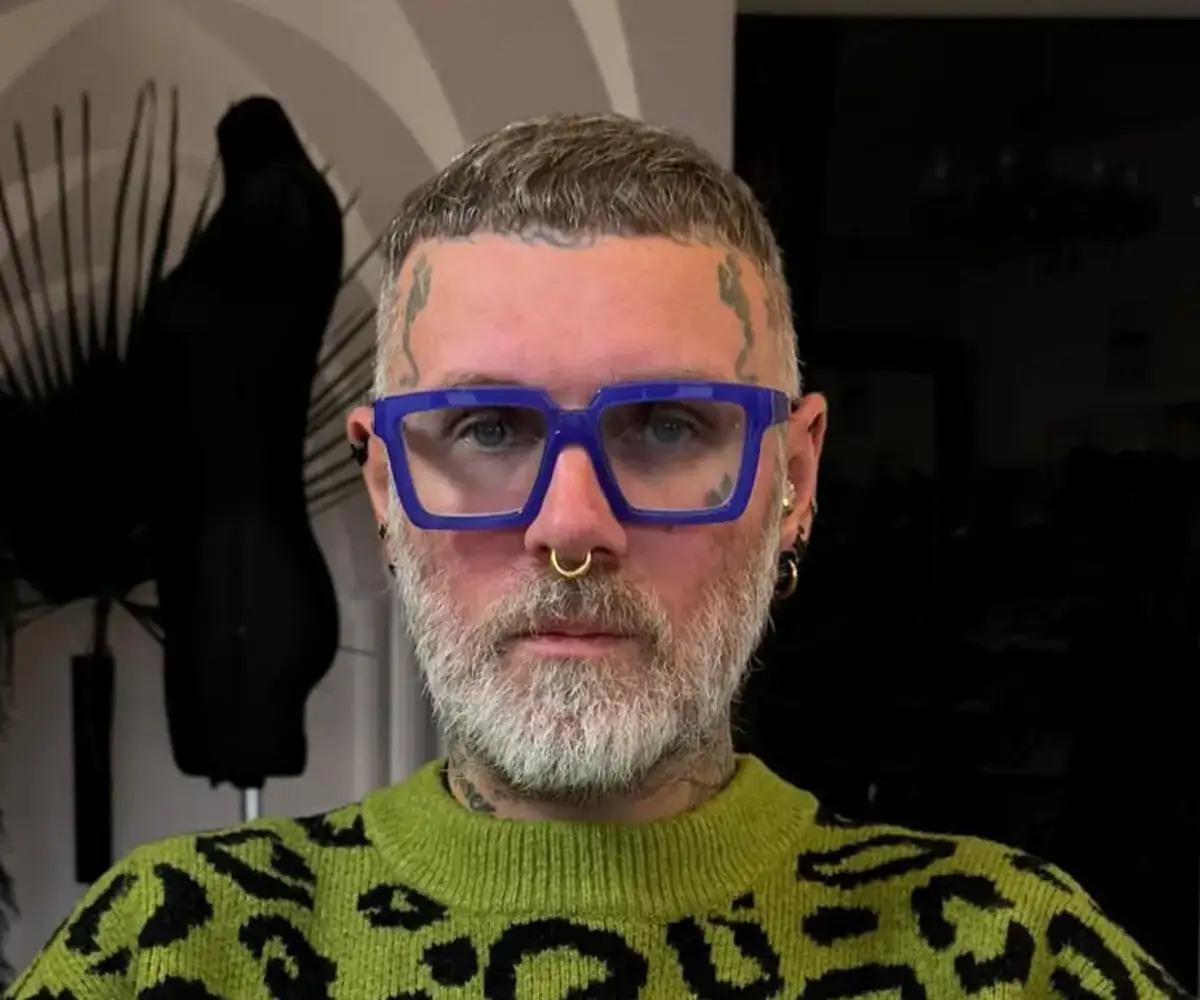 Liutauras Salasevicius vor der Haartransplantation mit sichtbarem Haarausfall und zurückgehendem Haaransatz