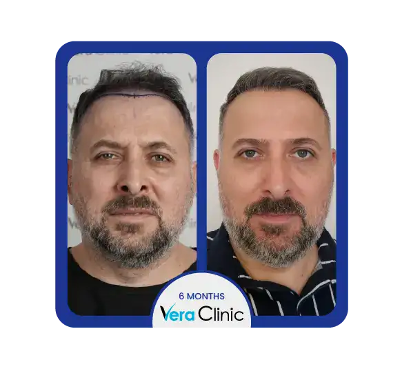 Sapphire FUE-Haartransplantation vor und nach der Behandlung in der Vera Clinic mit natürlicher Haarlinie und hoher Transplantatüberlebensrate