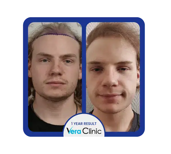 Sapphire FUE-Haartransplantation: Vorher-Nachher-Ergebnisse in der Vera Clinic zeigen präzises Design der Haarlinie und narbenfreie Heilung.