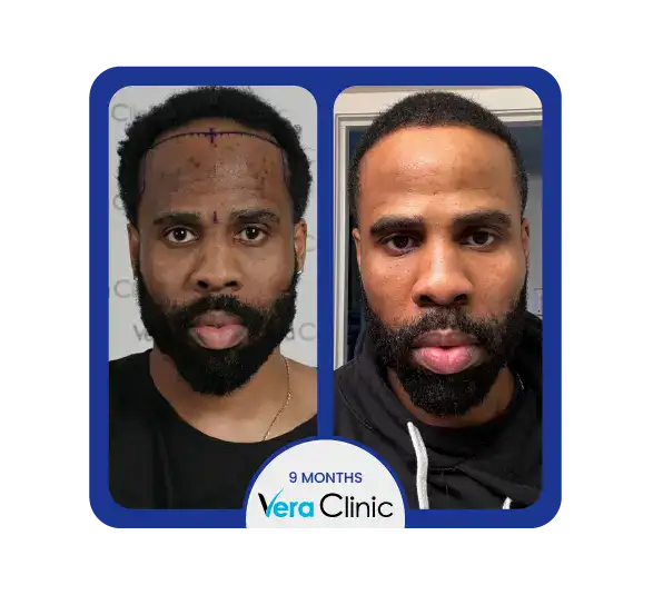 Vor und nach einer Afro-Haartransplantation in der Vera Clinic in Istanbul, die eine vollere Haarlinie und gleichmäßiges Wachstum für lockige Haartypen zeigt.