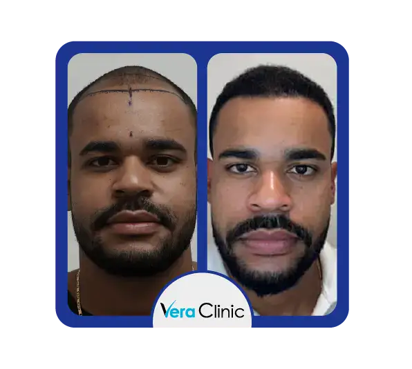 Ergebnisse einer Afro-Haartransplantation vor und nach der Behandlung in der Vera Clinic in der Türkei, die eine natürliche Wiederherstellung der Lockenstruktur und eine verbesserte Haardichte zeigen.