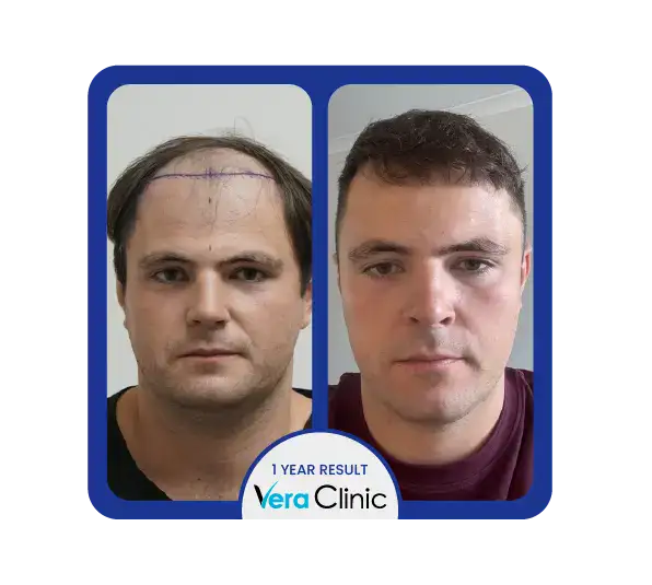 DHI-Haartransplantation vor und nach der Behandlung in der Vera Clinic, Istanbul, mit Betonung der Verbesserung der Haardicke und -abdeckung