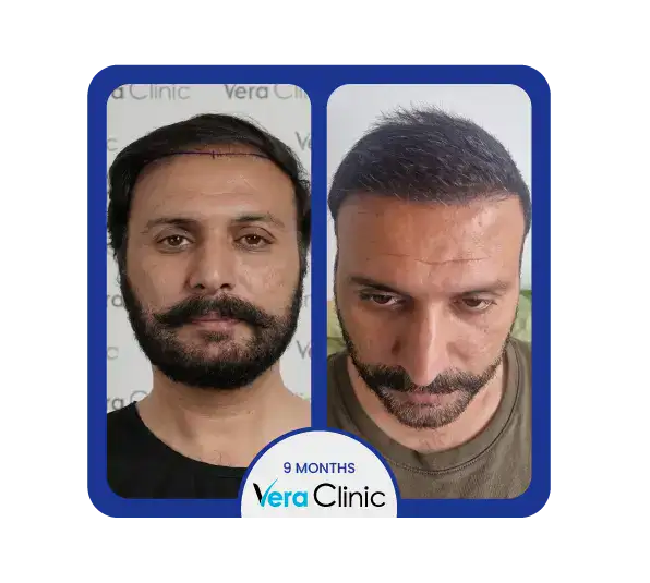 dhi vor und nach der Behandlung zeigt eine sichtbare Zunahme des Haarvolumens und des Haarwachstumsmusters in der Vera Clinic.