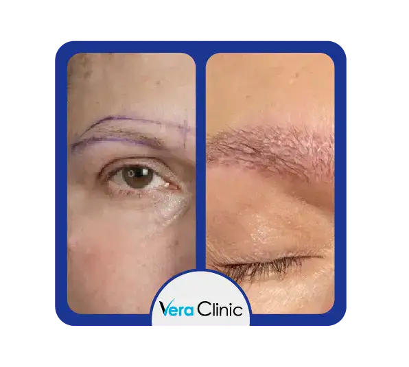 Vor und nach der Augenbrauentransplantation in der Türkei: Die Vera Clinic hebt das vollere und symmetrische Wachstum der Augenbrauen hervor.