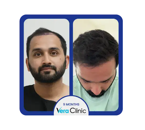 Ergebnisse der FUE-Haartransplantation in der Vera Clinic in der Türkei zeigen eine deutliche Verbesserung der Haardichte nach der Operation.