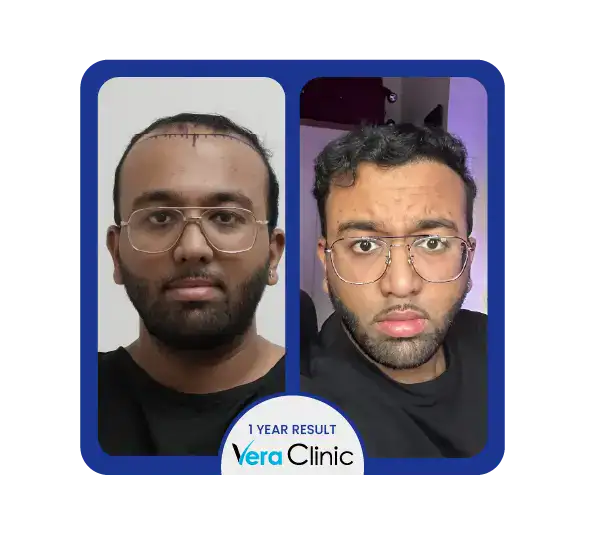 Vorher-Nachher-Vergleich einer Haarwiederherstellung mit Stammzellen, der eine schnellere Genesung und eine verbesserte Gesundheit der Kopfhaut in der Vera Clinic in der Türkei zeigt.