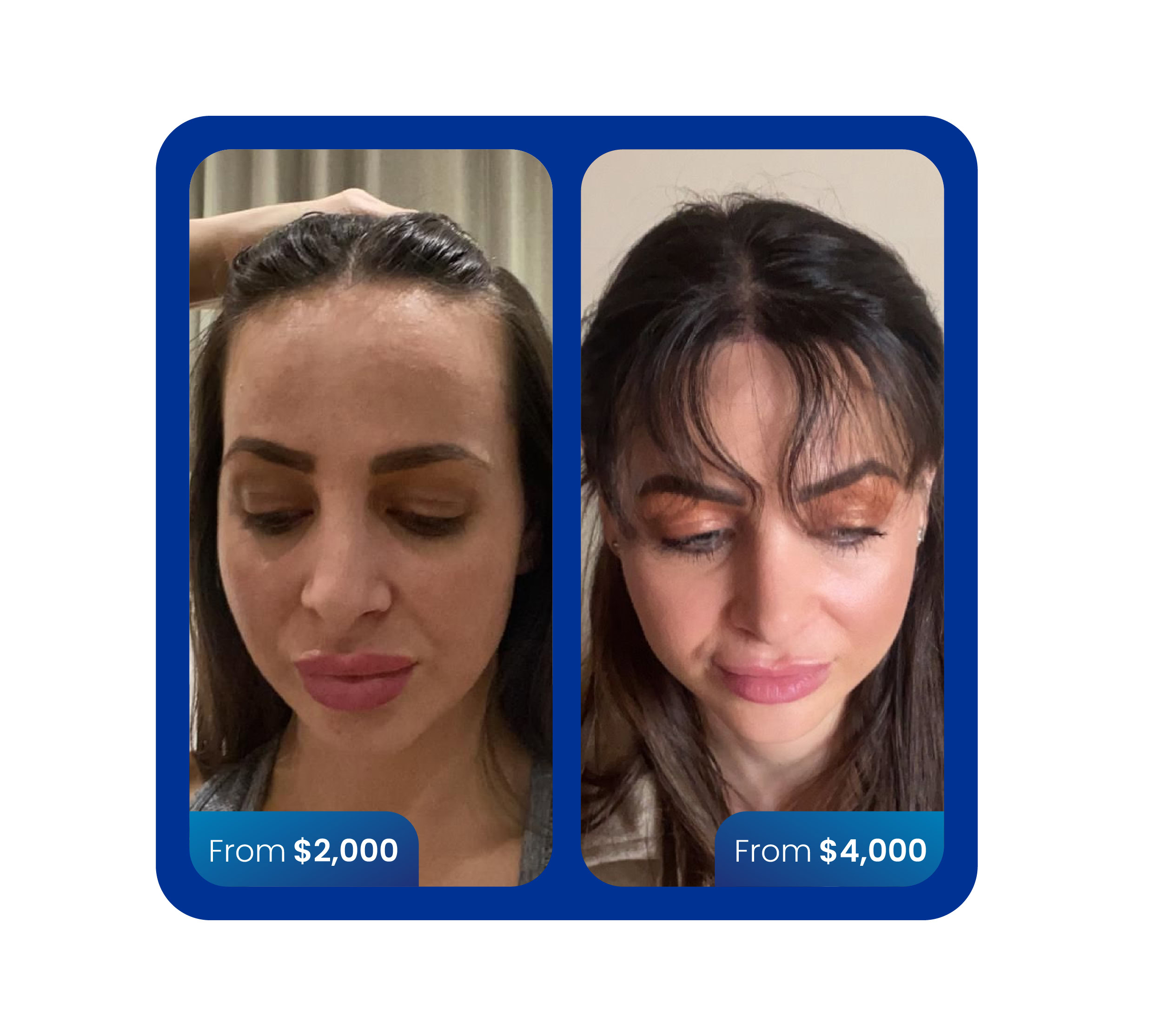 FUE hair transplant 5000 grafts before and after turkey cost