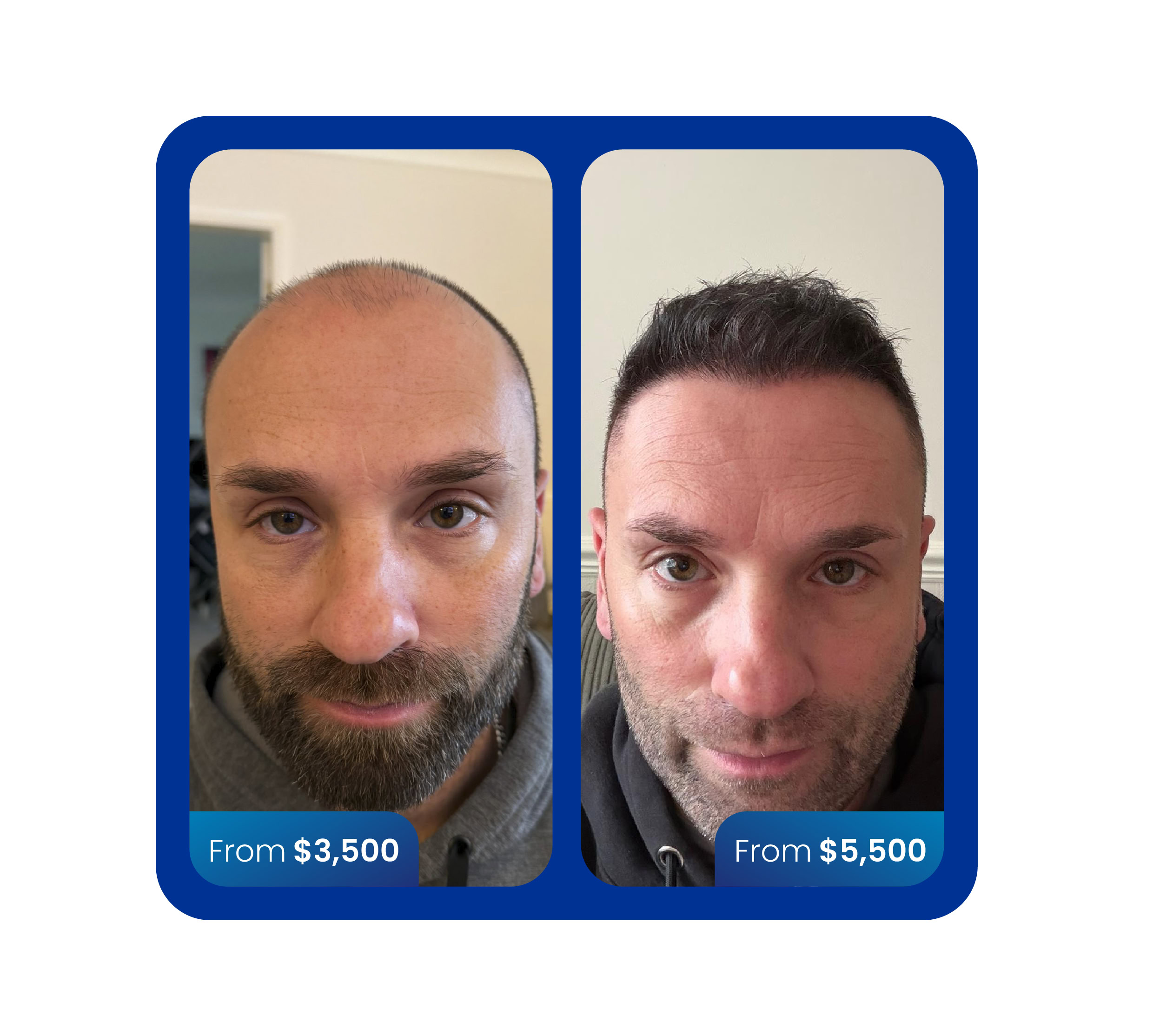 Sapphire fue hair transplant 4500 grafts before and after turkey cost