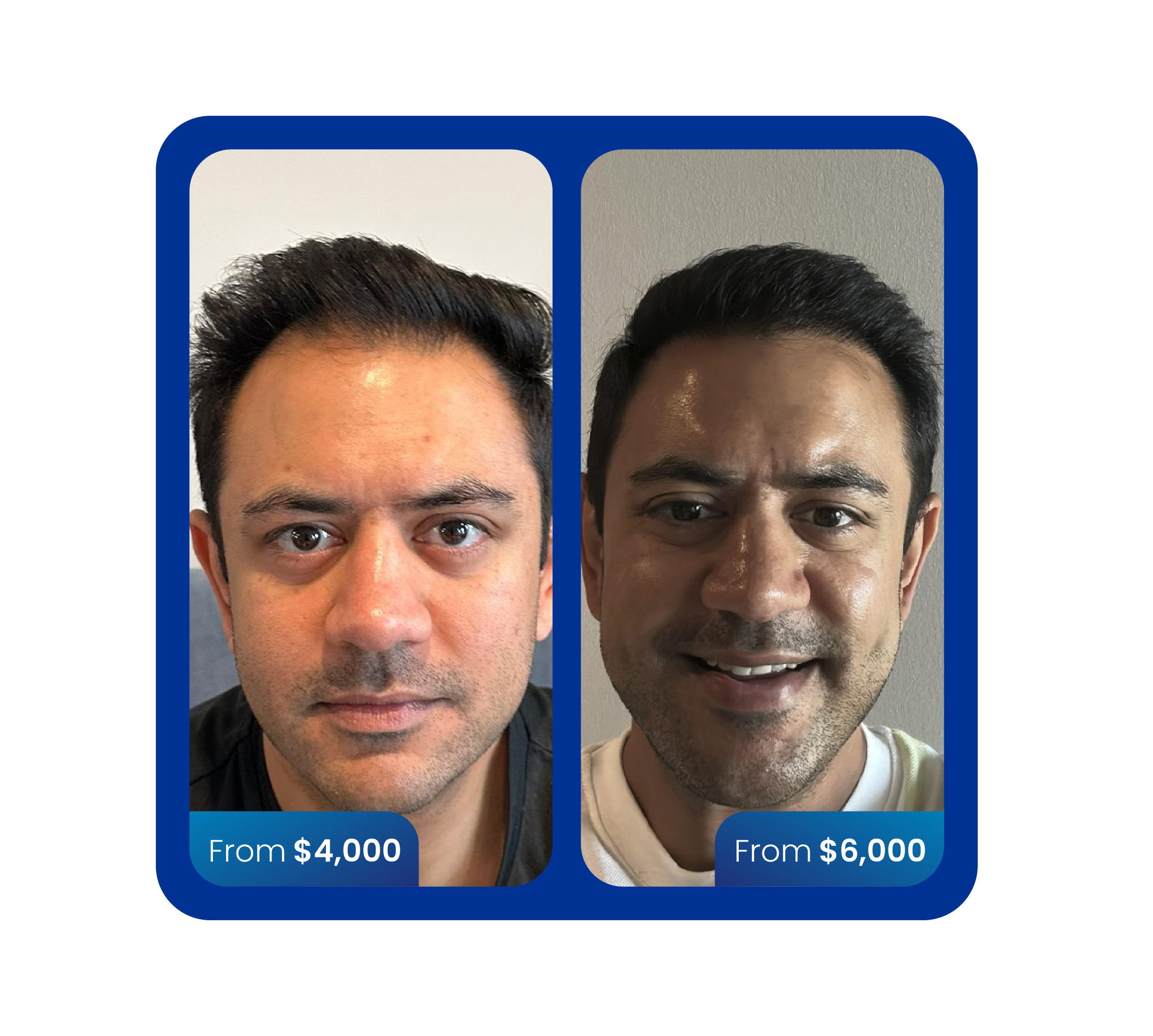 DHI hair transplant 4000 grafts before and after turkey cost