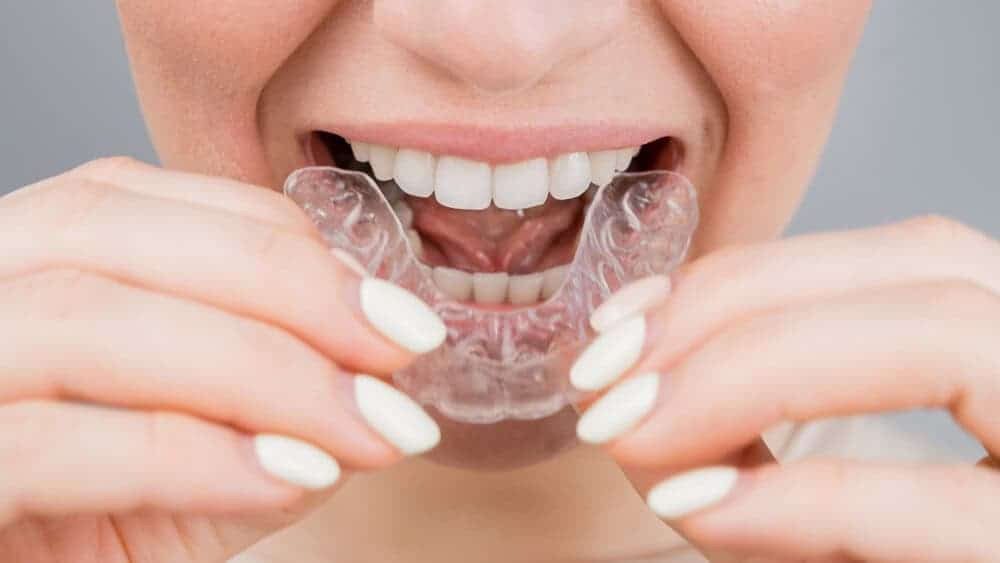 retainers for keeping your smile after braces