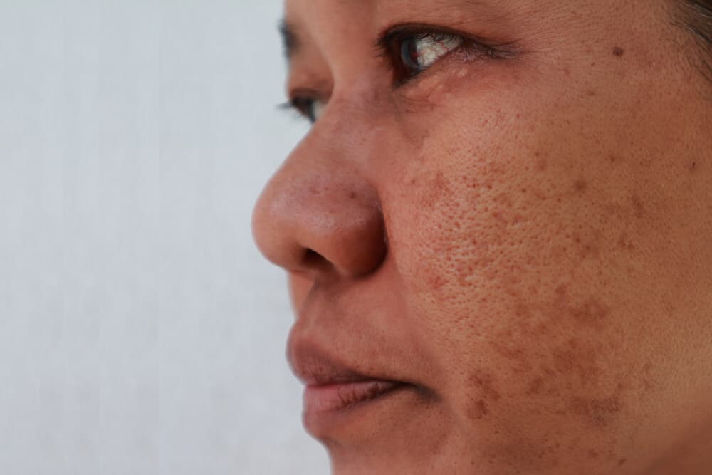 Melasma – How Effective is Laser Treatment