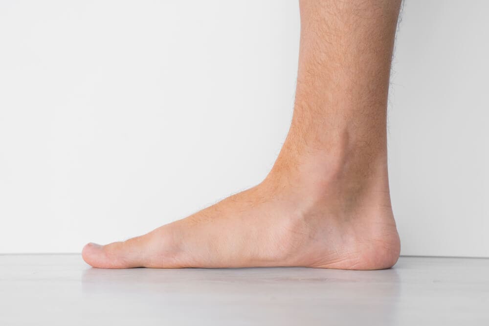 Living Well with Flat Feet Tips and Insights Rachel Bustin