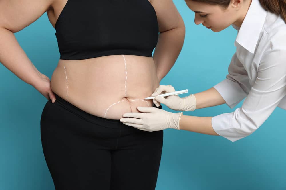 The Science Behind Liposuction: Understanding Techniques and Limitations