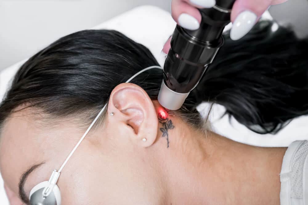 How Skin Type Changes Your Tattoo Removal Results