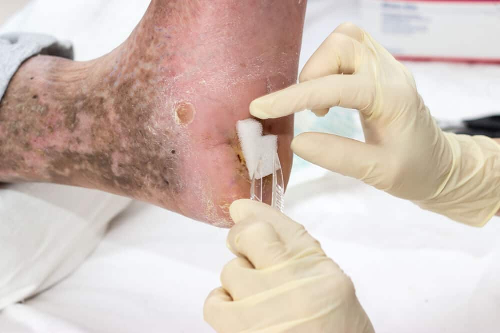 Treating a Diabetic Foot Ulcer