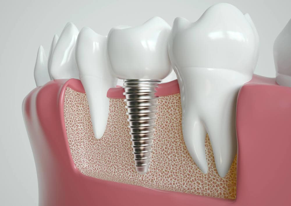 Missing Teeth? Here's Why Dental Implants Are a Long-Term Solution