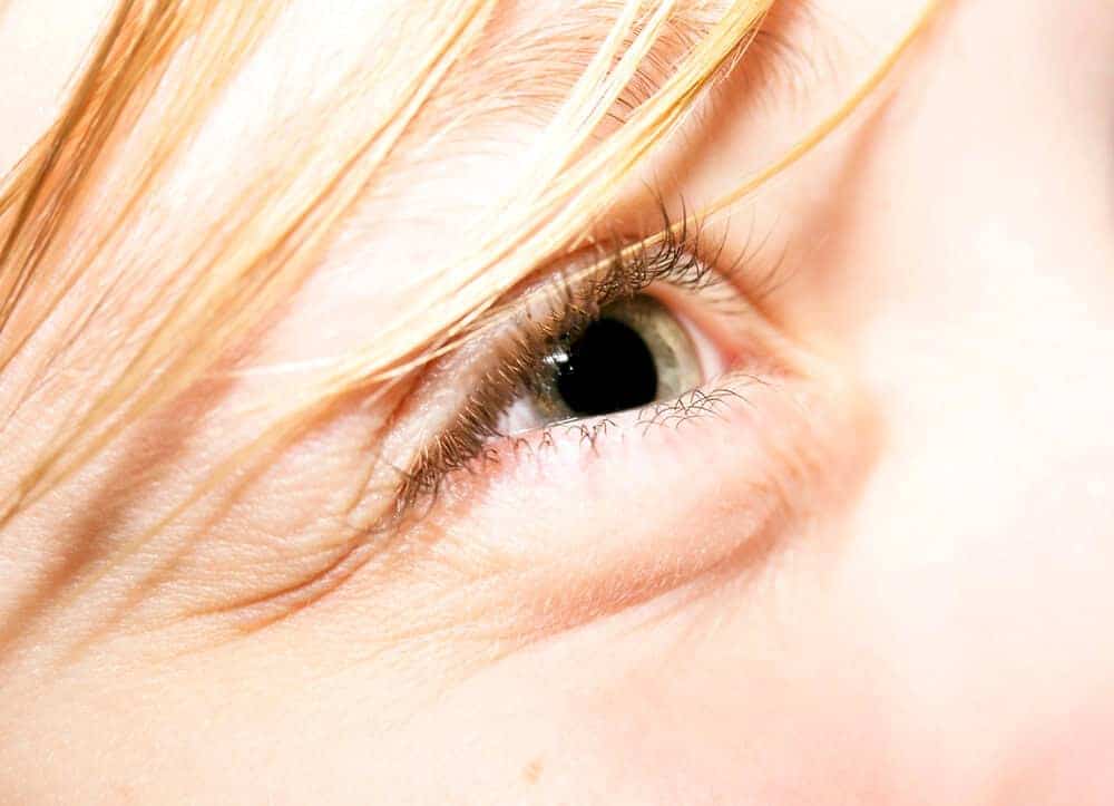 Puffy Eyes or Sagging Eyelids