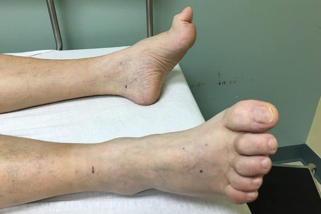 hammertoes