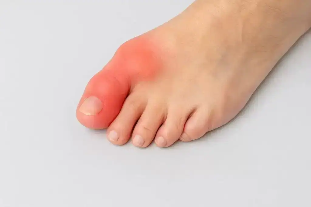 hallus rigidus foot