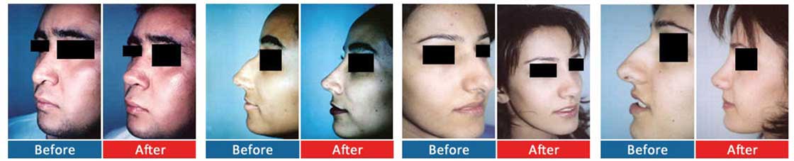 Rhinoplasty,Nasal Surgery Rhinoplasty, Female & Male Rhinoplasty nasal3