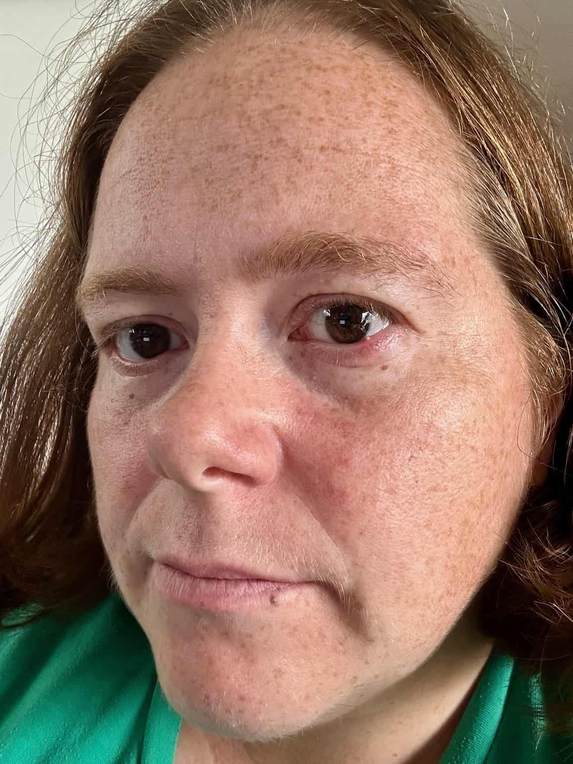 BEFORE pic Laser Red Light Mask