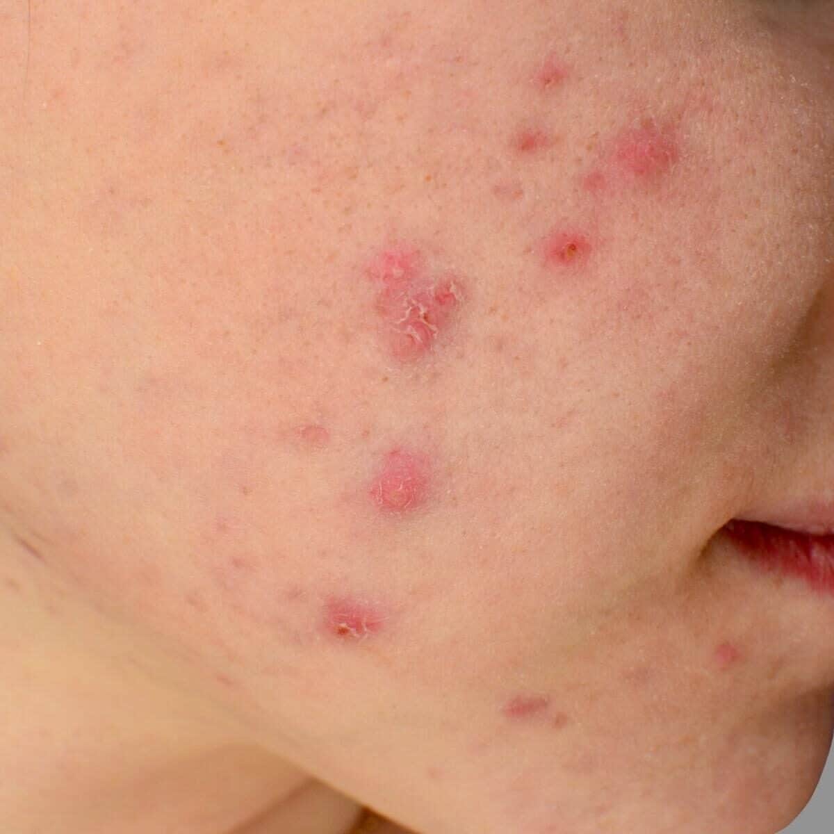 face with acne close up