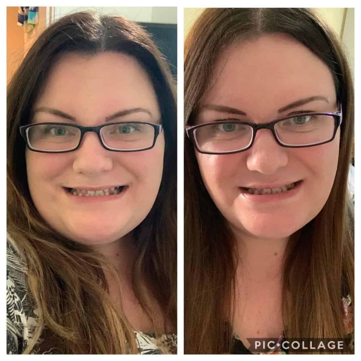 Emma\'s weight loss surgery experience selfies