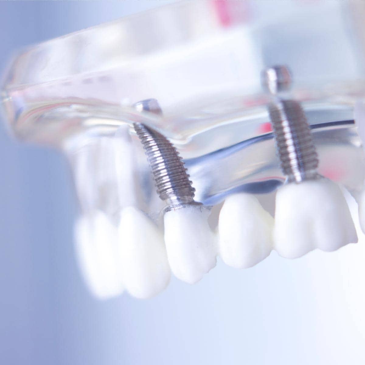 dental implants shown in a fake jaw.