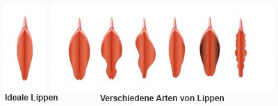 labiaplastie
