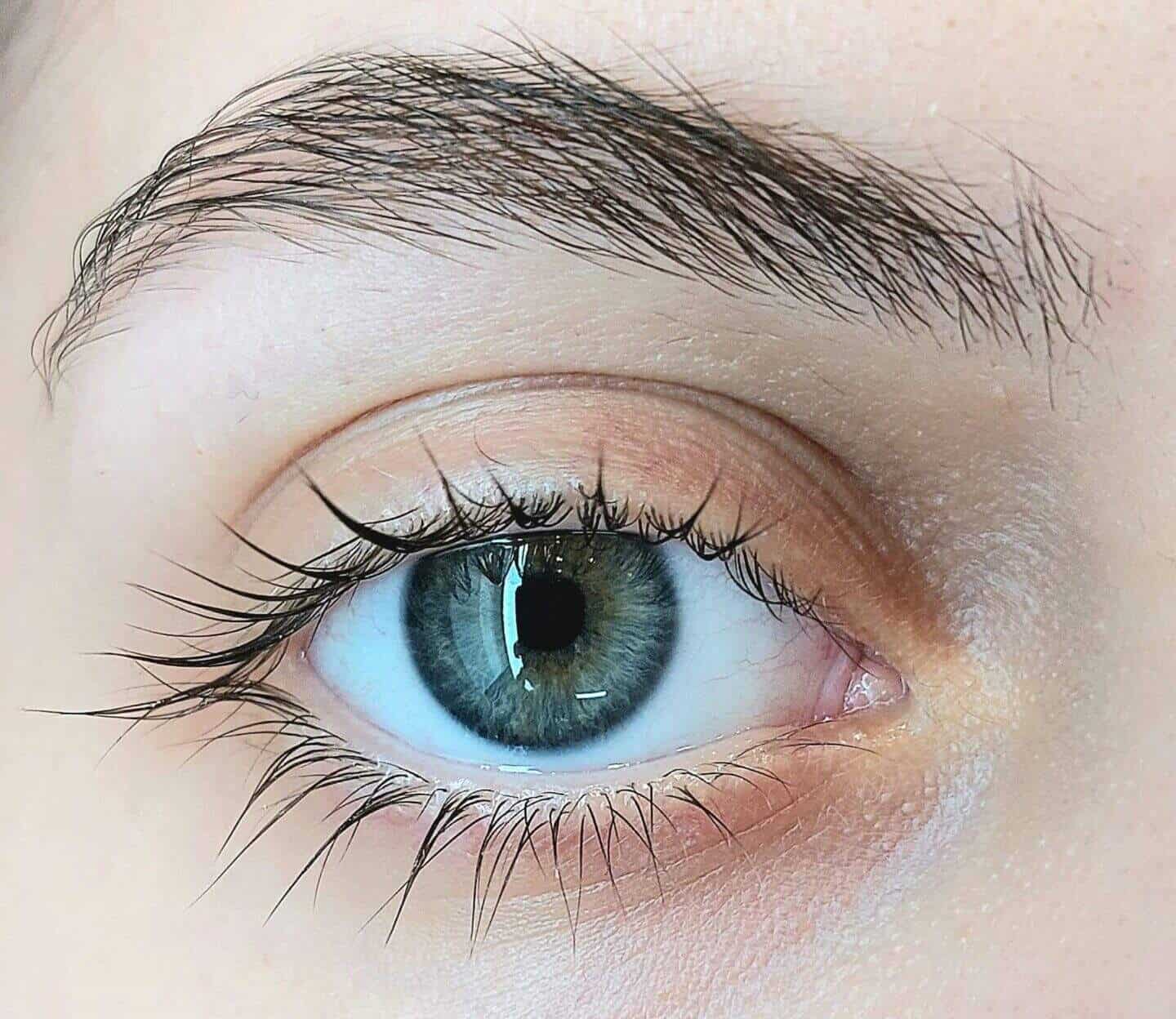 How Eyelid Changes Can Affect Facial Balance and Expression