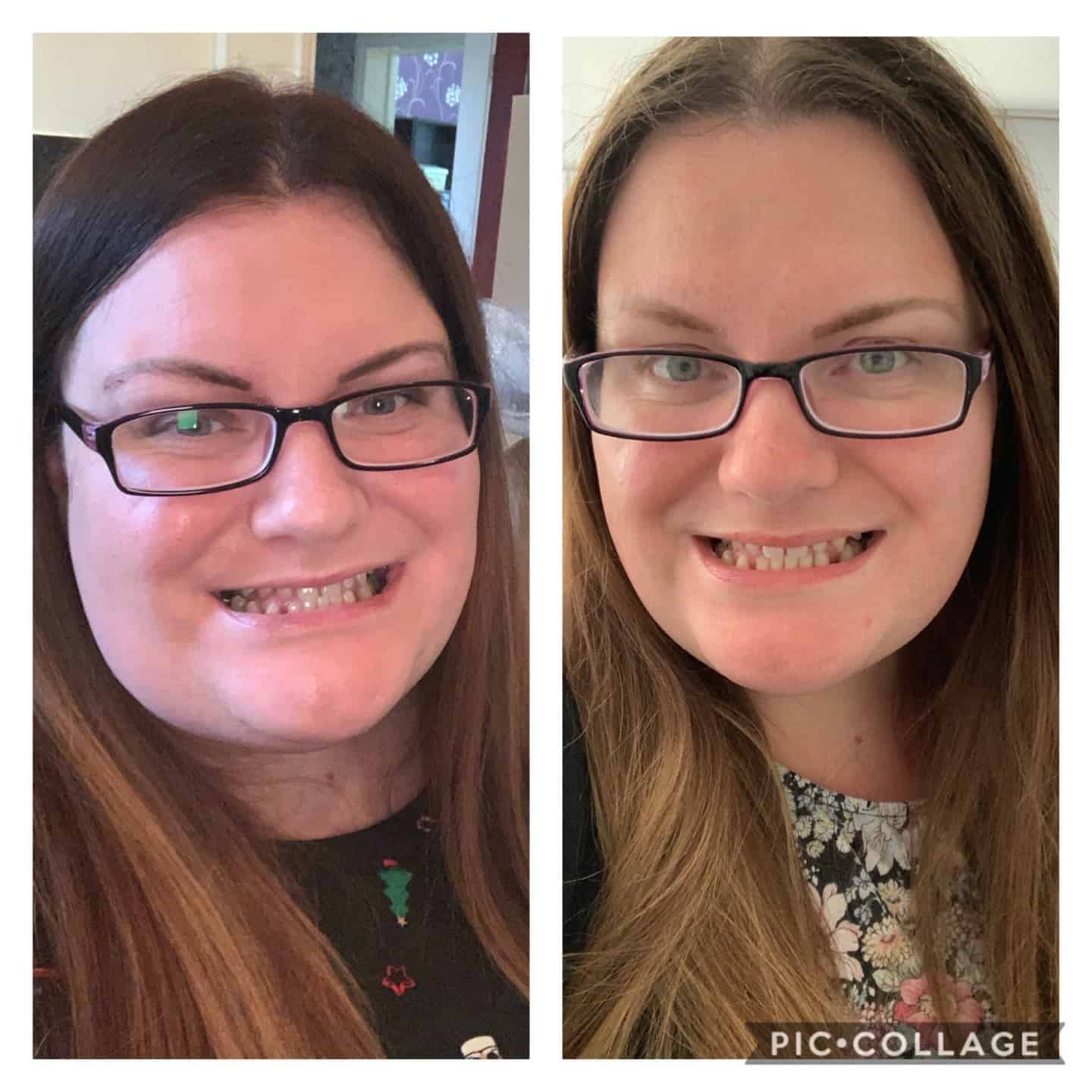 Smiling Emma before and after
