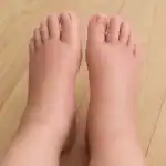 swollen feet | edema