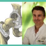 Hüftdysplasie Symptome: Experte PD Dr. Dornacher