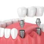 How Much Is A Full Mouth Of Dental Implants