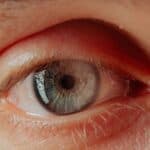 Still Look Tired After a Full Night’s Sleep? Eyelid Surgery Could Help
