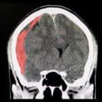 Is Surgery Always Needed for a Subdural Hematoma